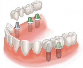 Зубные мосты на имплантантах