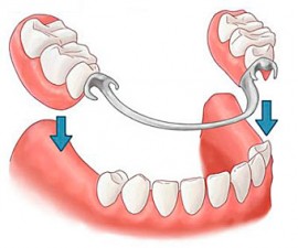 Доступное протезирование зубов в Пензе