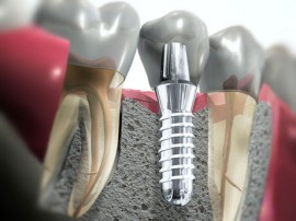 Протезирование зубными коронками из современных материалов