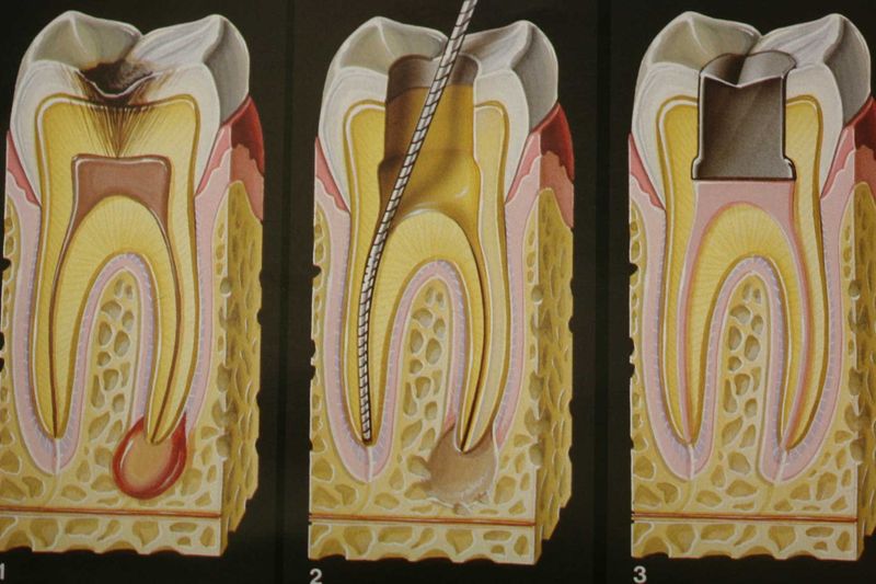 Эффективное лечение каналов зубов