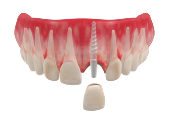 Одиночные коронки - имплантация одного зуба