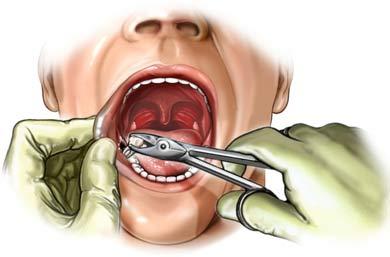 Безболезненная стоматологическая хирургия