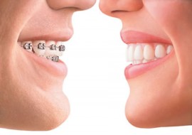 Незаметное выравнивание зубов с помощью прозрачных капп Инвизилайн 