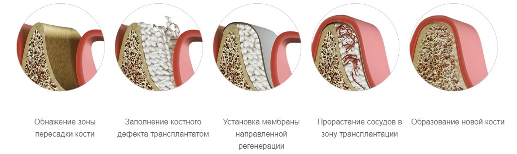 Костная пластика в стоматологии при имплантации
