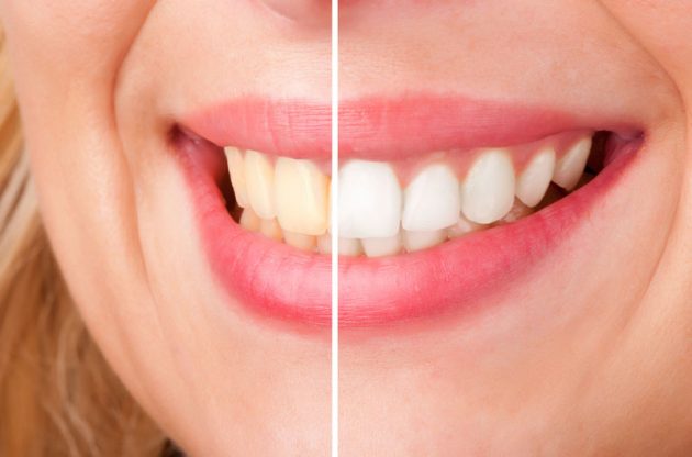 Каковы причины потемнения зубов?