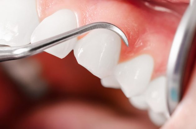 Можно ли одновременно лечить и удалять зубы