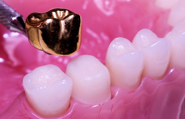 Что такое зубная коронка?