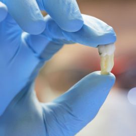 Преимущества удаления зубов мудрости в клинике «Юдент»