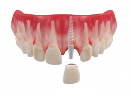 Одиночные коронки — имплантация одного зуба