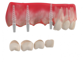 Частичный мостовидный протез — восстановление нескольких зубов