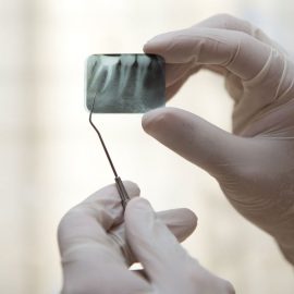 Лечение кисты зуба в Пензе в стоматологии "Юдент"