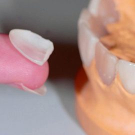 Наращивание зубов в Пензе в стоматологии «Юдент»