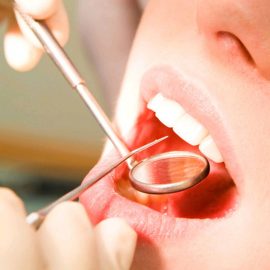 Лечение кисты зуба в Пензе в стоматологии "Юдент"