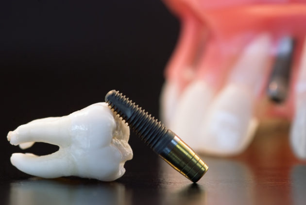 экспресс имплантация зубов