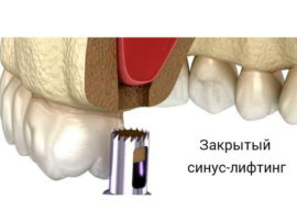 Закрытый синус лифтинг