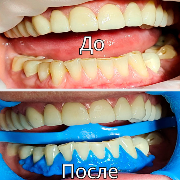 Отбеливание зубов нижней челюсти системой Beyond Мax. Работа терапевта Малининой Л.В