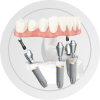 Имплантация всех зубов на 4-6 имплантах в Пензе без боли с пожизненной гарантией